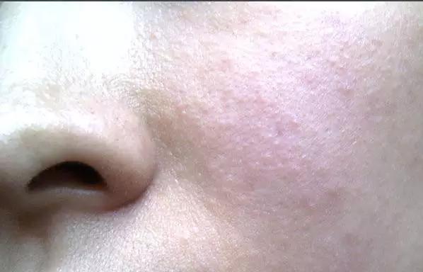 痘痘科普视频,痘痘知识科普祛痘印