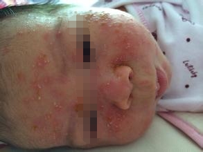 孩子妈妈一脸痘怎么避免孩子长痘,一岁半宝宝长青春痘