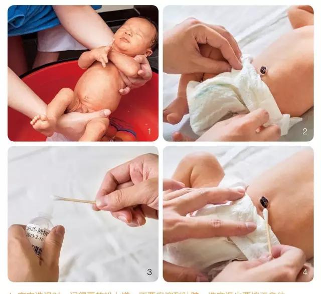新生儿脐带护理消毒顺序,宝宝脐带消毒图解步骤