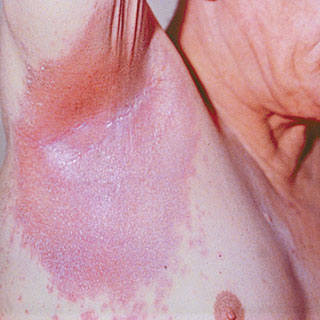 疾病常识:什么是反向性银屑病