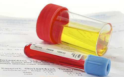 血尿病有多恐怖,肉眼血尿和镜下血尿常见疾病