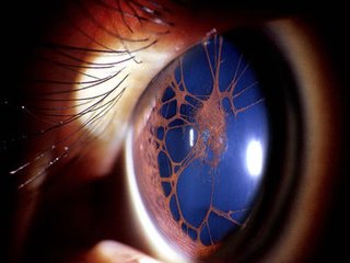 眼前有闪光感,眨眼的时候眼前有闪光感