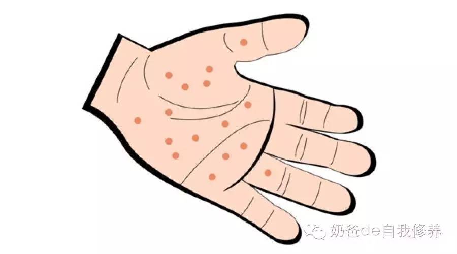 手足口和疱疹性咽颊炎治疗一样吗,手足口和疱疹性咽峡炎会同时得吗