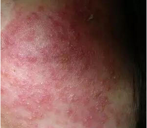 激素脸怎么护理,激素脸怎么护理修复