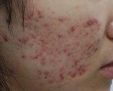 脸上有红色痘印而且脱皮,脸上的红色痘印怎么消除