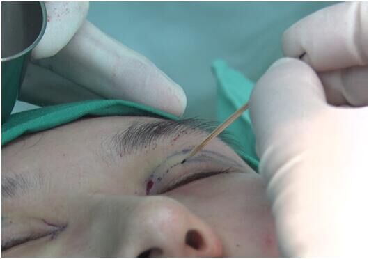 正常双眼皮和割的双眼皮区别,双眼皮有几种全切