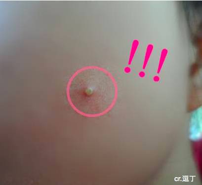 长痘痘怎么才能不留印,长痘痘了怎么消除不留疤