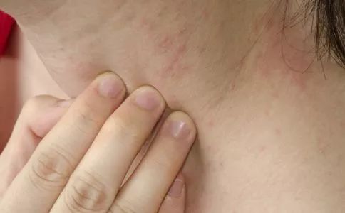 湿疹看中医效果好还是西医效果好,湿疹痒中药外用怎么止痒