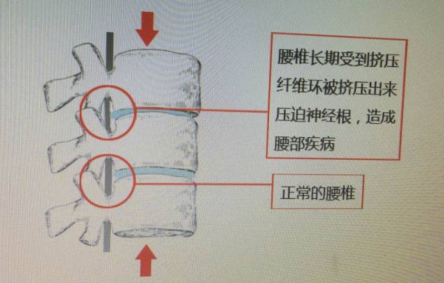 腰椎间盘突出的真相您了解吗,腰椎间盘突出是实证还是虚证