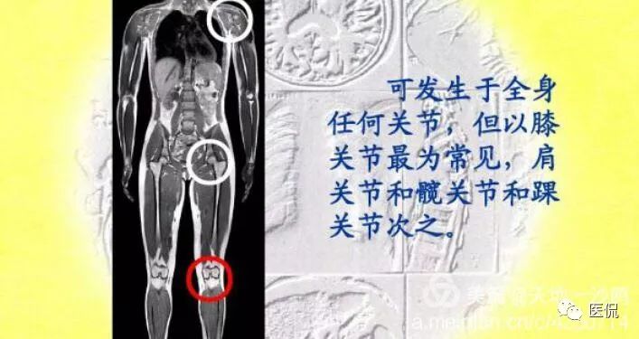 膝关节创伤性积脂血症的临床表现,创伤性积脂血症什么意思