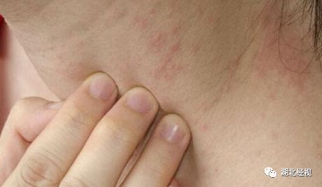 皮疹是癌症前兆吗,皮疹肺癌