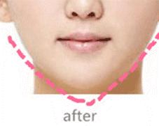 瘦脸针注意事项禁忌,瘦脸针的使用方法及注意事项