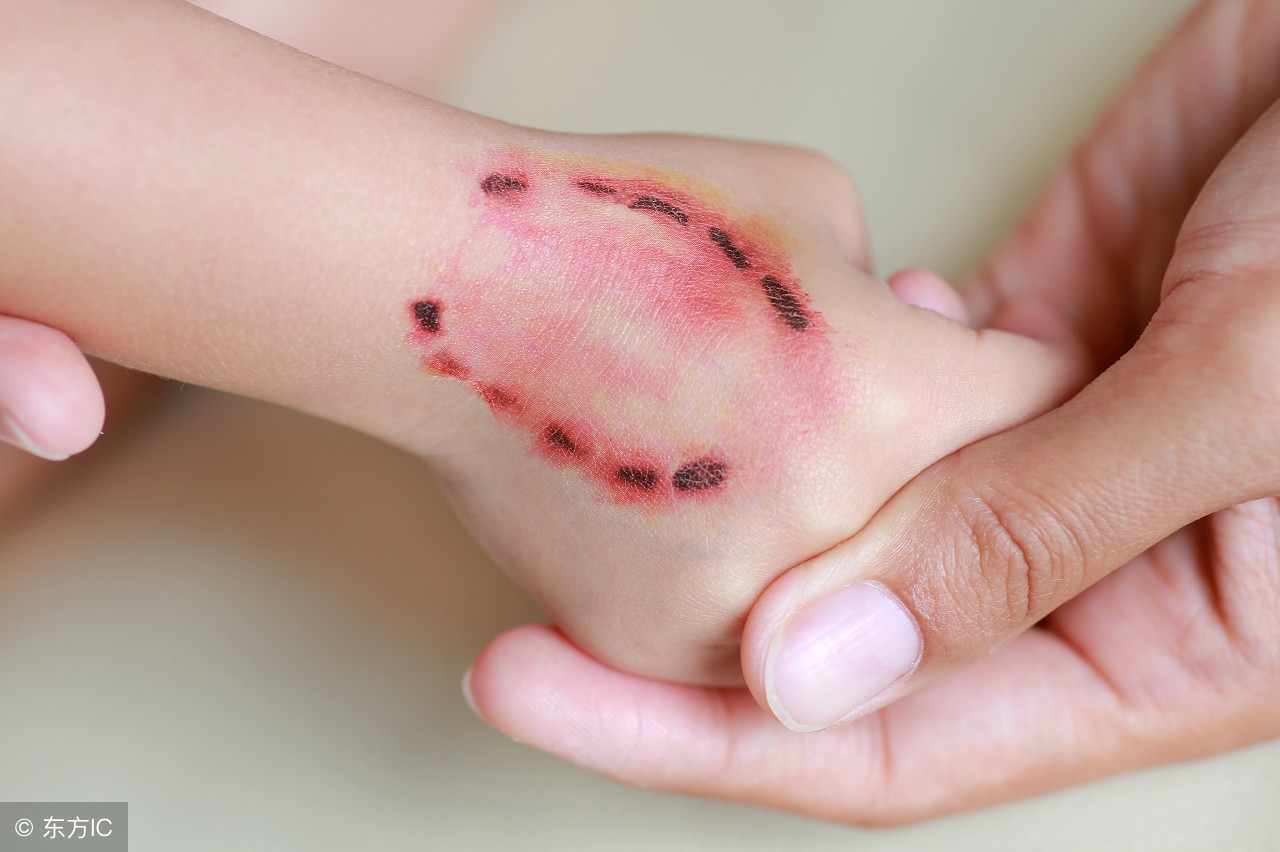 恐狂症与狂犬病的敏感区别,恐狂是什么