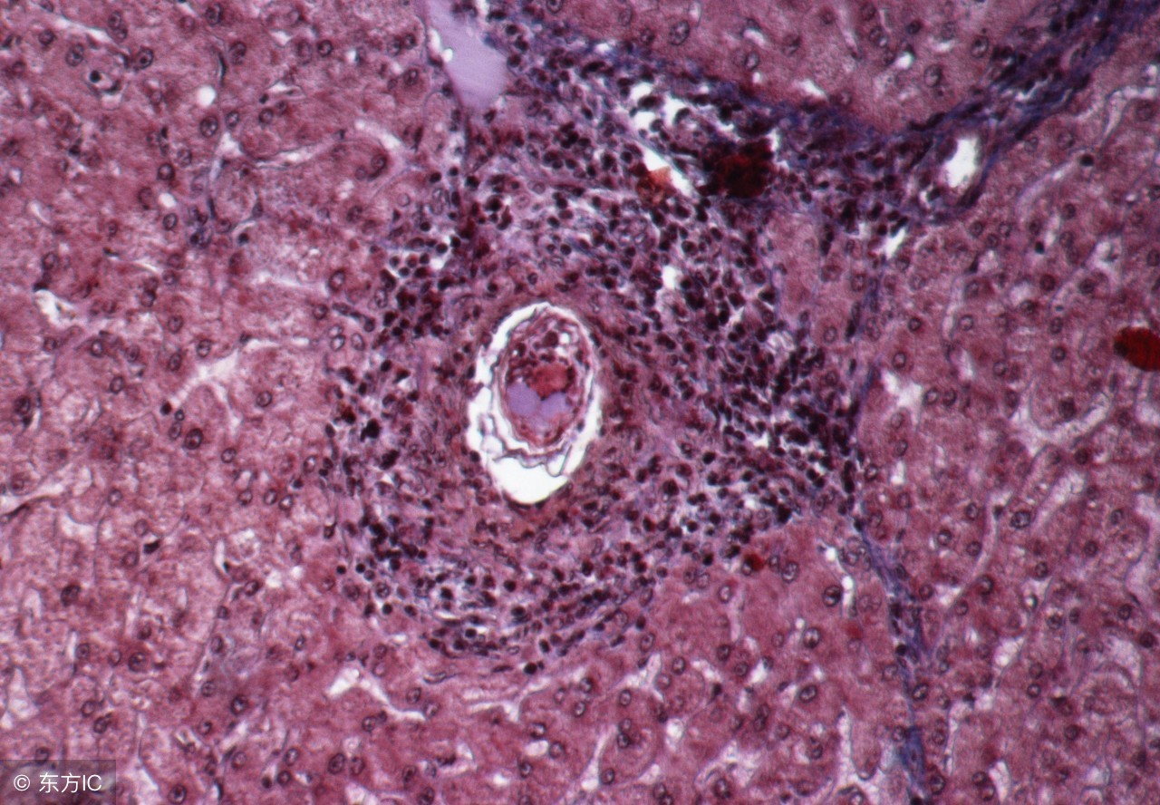 肝血管瘤临床诊疗指南最新版,肝血管瘤10mm没有任何症状