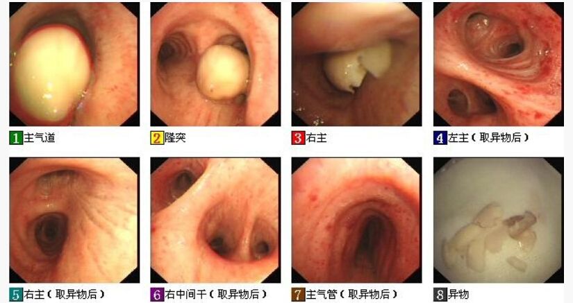 吃东西呛进气管该怎么办,吃饭时被食物呛入气管怎么办