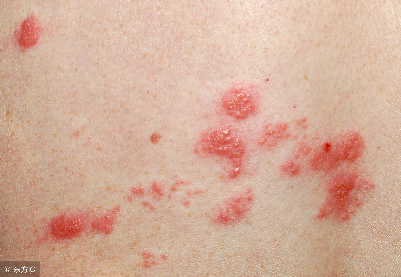 带状疱疹的原因中医,带状疱疹是什么原因引起的危险吗