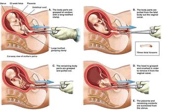 人工流产是怎样做的,人工流产最好的方法是什么