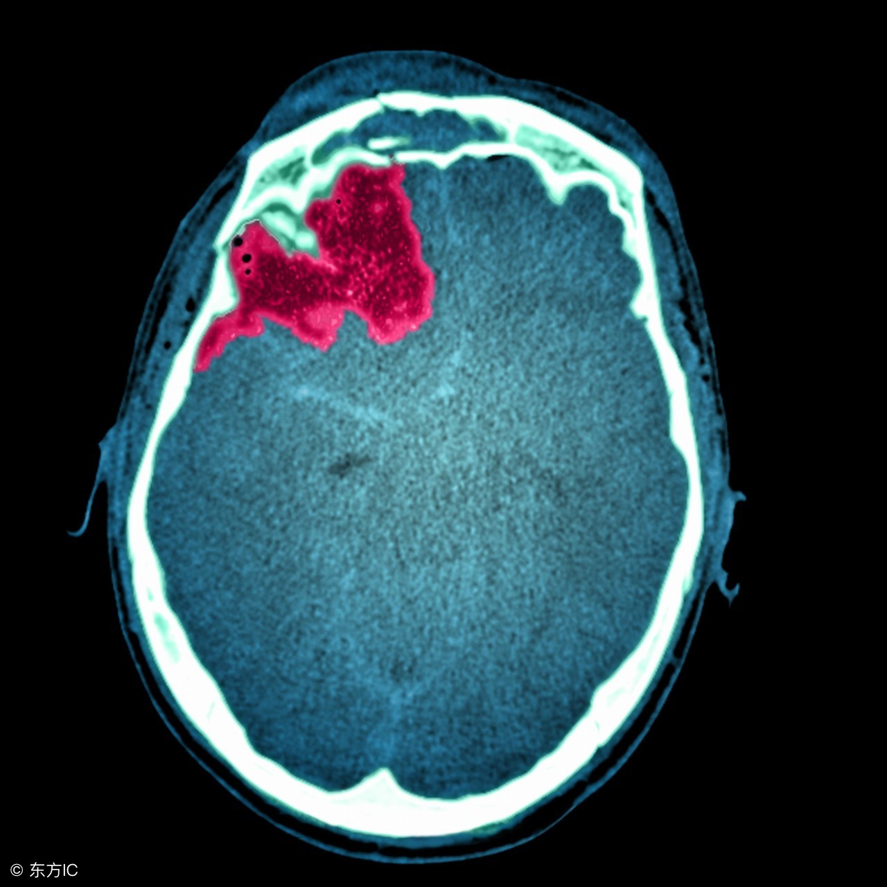 脑出血后康复饮食菜谱做法大全,高血压脑出血后饮食及注意事项