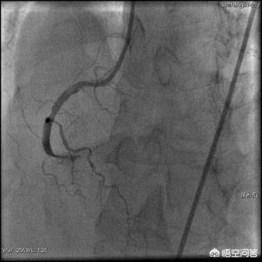 心脏有三根大血管，堵死一根还能正常工作吗？