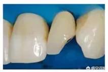 牙齿坏了一半应该补还是做牙冠,儿童要换的牙齿坏了需要补吗