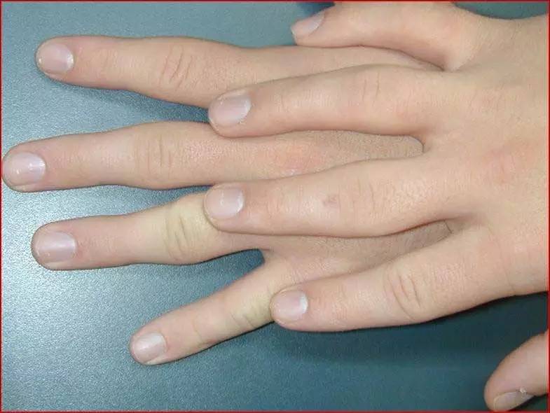 肩手综合征康复干预方法,肩手综合征康复治疗