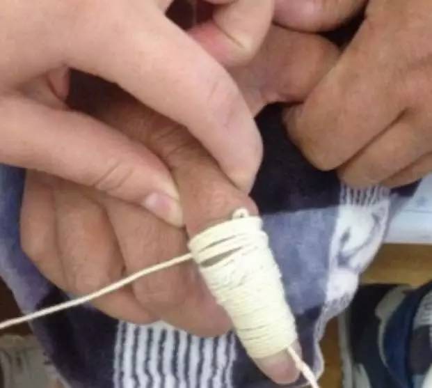 肩手综合征康复干预方法,肩手综合征康复治疗