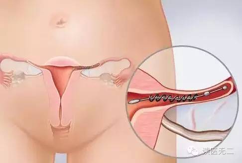 第四代避孕药怎么样,第4代避孕药有哪些