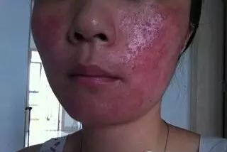 激素脸怎么护理,激素脸怎么护理修复