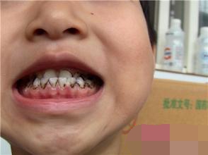 2岁小孩一口黑牙怎么办,一岁宝宝满口黑牙怎么回事