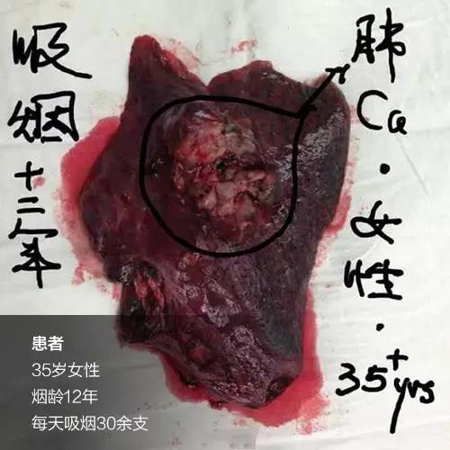 国外烟盒警示图片,看了这些你还想吸烟吗?