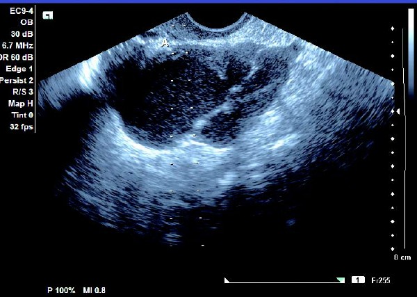 卵巢巧克力囊肿癌变的10个征兆,卵巢巧克力囊肿5.4厘米必须手术吗