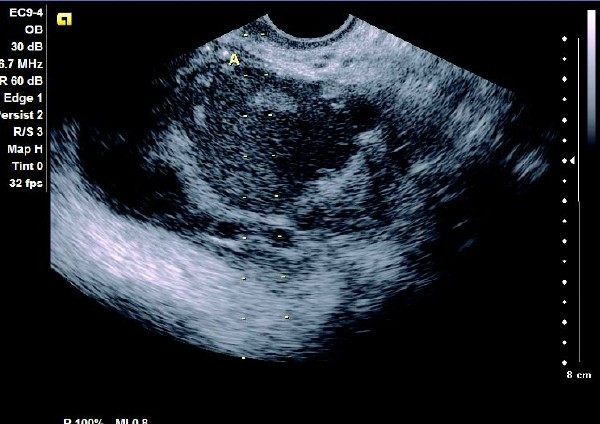 卵巢巧克力囊肿癌变的10个征兆,卵巢巧克力囊肿5.4厘米必须手术吗