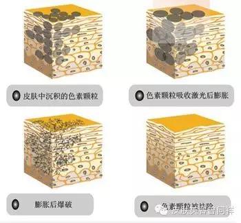 激光祛斑小贴士,极q激光祛斑