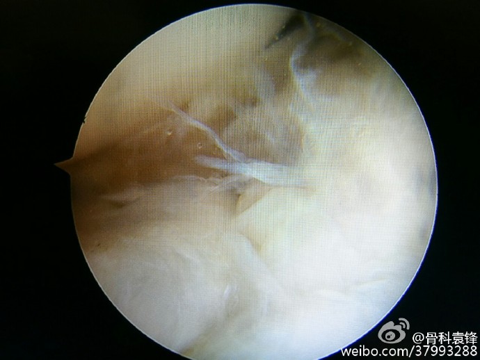 盘状半月板损伤能否自行修复,盘状半月板损伤后怎么治疗