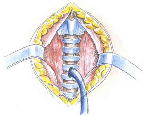 气管切开术急救切哪里,气道切开急救