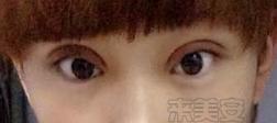 割双眼皮后悔的多还是不后悔的多,割双眼皮为什么前30天就那么难看
