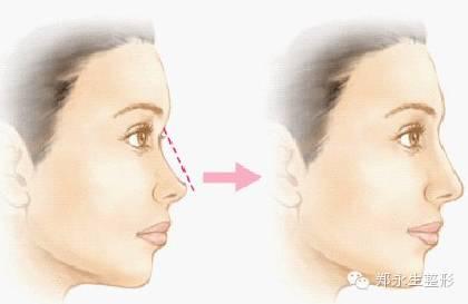 鼻整形有黄金阶段吗,怎么提高鼻子整形成功率