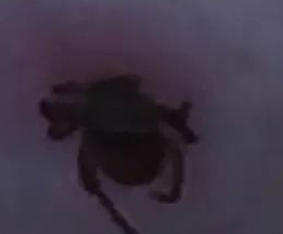 踏青季警惕蜱虫叮咬,被蜱虫叮咬后一定会得莱姆病吗