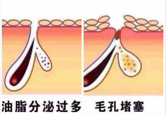 去黑头舒缓压力,教你如何去黑头