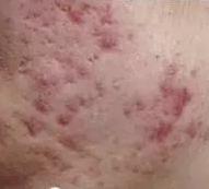 痘印的种类及成因,红色痘印成因