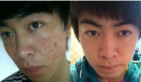 痘痘长哪里不烦人,痘痘在哪几个地方不要挤掉