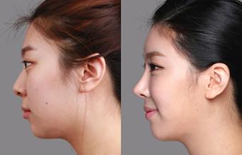 耳软骨隆鼻为什么鼻头还是很大,耳软骨隆鼻需要假体吗