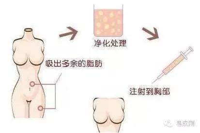 自体脂肪填充——你还在嫌弃堆积的脂肪吗?