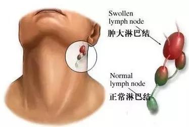 小孩子耳后淋巴结肿大怎么治,小孩子颈部淋巴结肿大的原因
