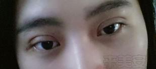 割双眼皮后悔的多还是不后悔的多,割双眼皮为什么前30天就那么难看