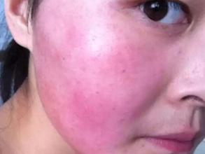 脸过敏发红发痒紧急处理妙招,脸过敏不痒了但是还发红怎么回事