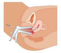 孕妇顺产侧切一般多少天恢复,顺产侧切和撕裂哪个好恢复