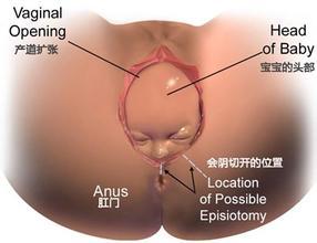 孕妇顺产侧切一般多少天恢复,顺产侧切和撕裂哪个好恢复