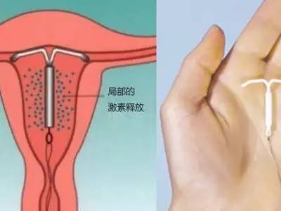 什么样的女性不适合上环,单身女性上环是什么心态