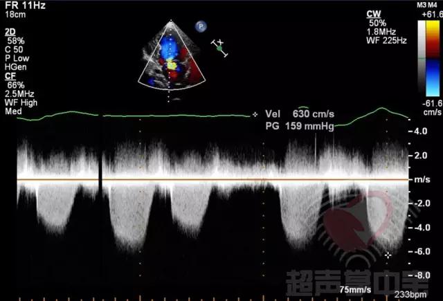 经典病例▏二尖瓣囊肿中竟然全是血液？